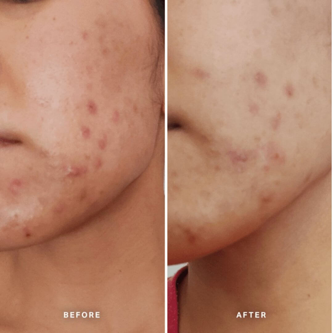 Clear Skin Tonic Before and After